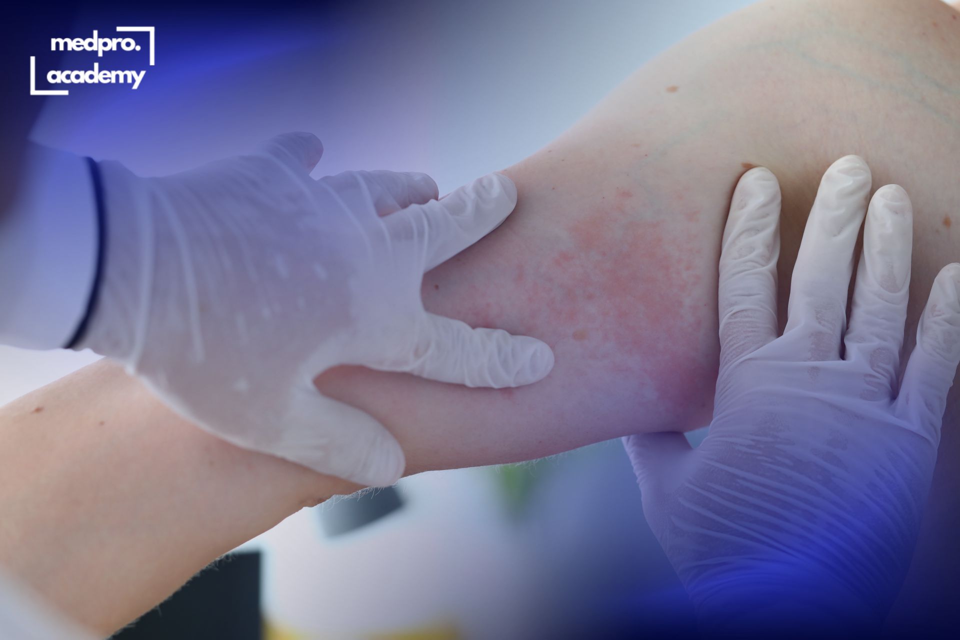 1Атопічний дерматит